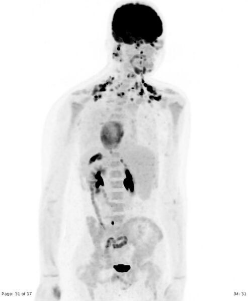 File:Brown fat uptake (FDG PET-CT) (Radiopaedia 77392-89513 MIP 30).jpg