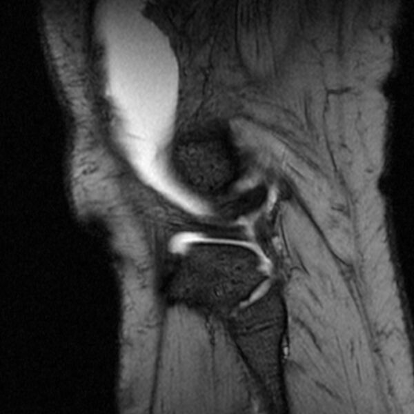 File:Bucket handle tear - medial meniscus (Radiopaedia 79028-91942 D 3).jpg