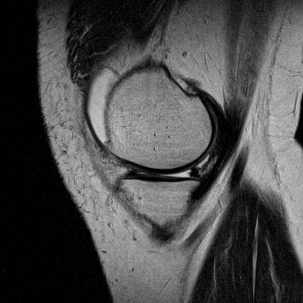 File:Bucket handle tear - medial meniscus (Radiopaedia 79028-91942 Sagittal T2 20).jpg