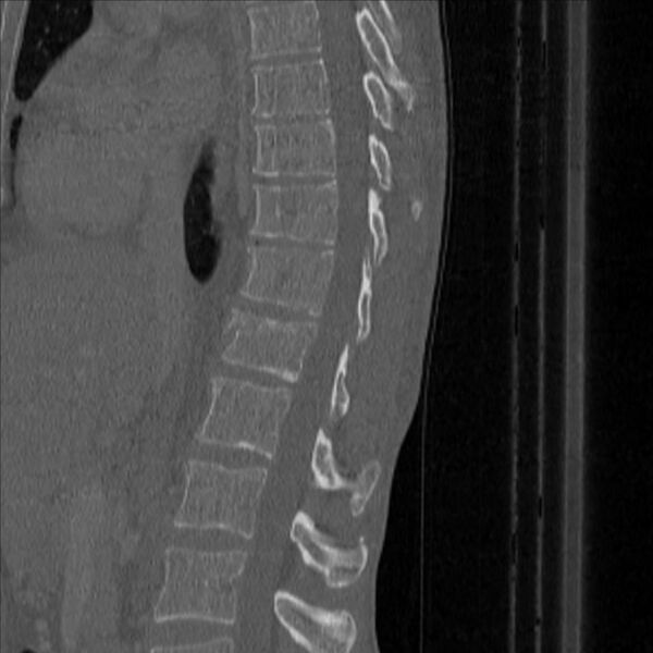 File:Bulging of paraspinal line in traumatic thoracal spinal compression fracture (Radiopaedia 29221-35872 Sagittal bone window 28).jpg