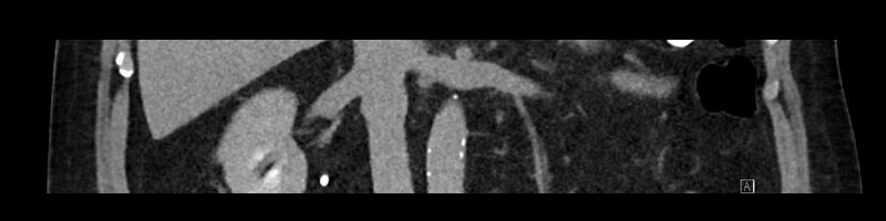 File:Buried bumper syndrome - gastrostomy tube (Radiopaedia 63843-72575 Coronal Inject 52).jpg