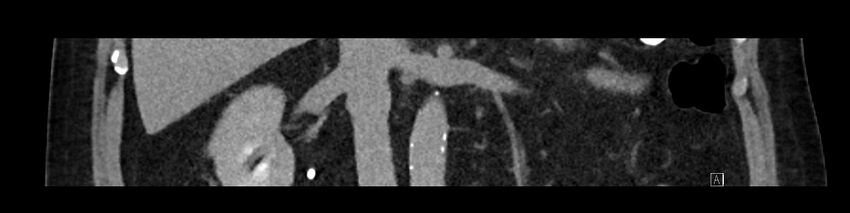 Buried bumper syndrome - gastrostomy tube (Radiopaedia 63843-72575 Coronal Inject 52).jpg