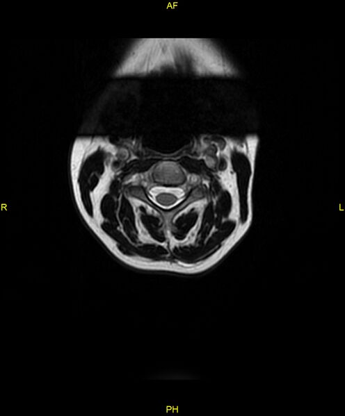File:C5 nerve sheath tumor (Radiopaedia 85777-101596 Axial T2 4).jpg
