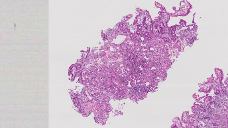 File:CMV duodenitis (histology) (Radiopaedia 27528-27734 A 1).jpg