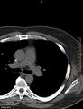 Calcified cardiac fibroma (Radiopaedia 39267-41519 Axial non-contrast 2).jpg
