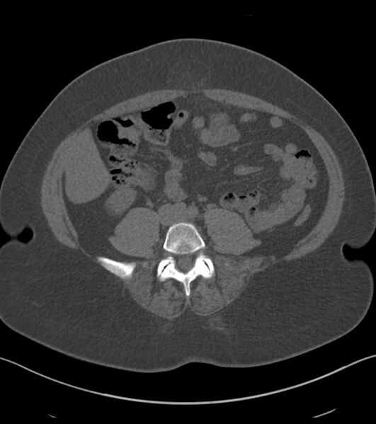 File:Calcified hepatic hydatid cyst (Radiopaedia 81127-94738 Axial non-contrast 63).jpg