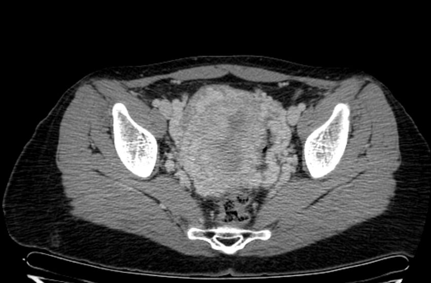 Cannonball metastases - uterine choriocarcinoma (Radiopaedia 70137-80174 A 26).jpg