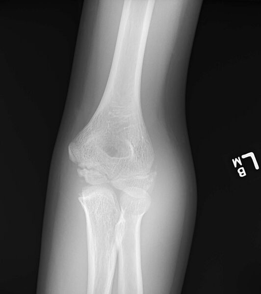 File:Capitellum fracture (Radiopaedia 23352-23425 Frontal 1).jpg