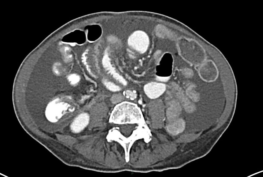 Carcinoid mesenteric tumor complicated by chylous ascites (Radiopaedia 76312-87953 A 44).jpg