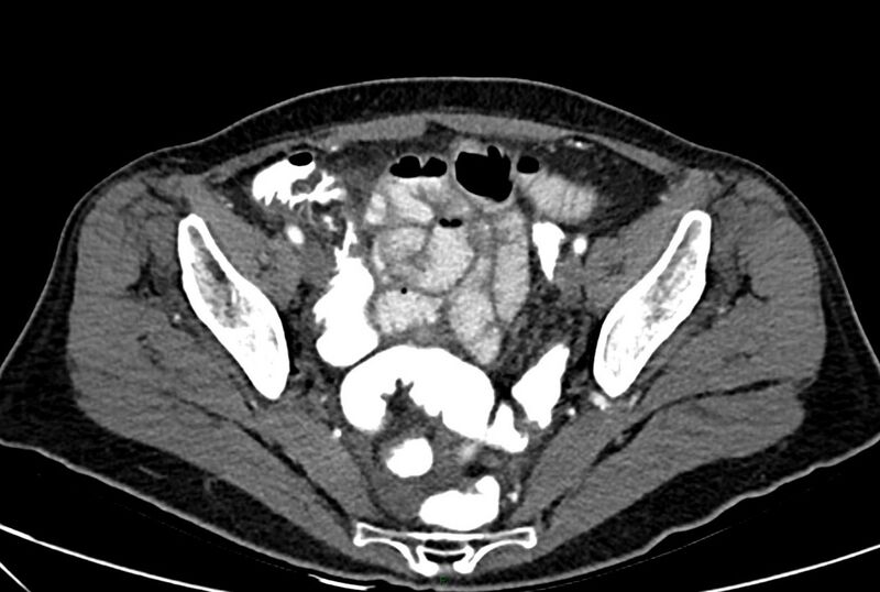 File:Carcinoid mesenteric tumor complicated by chylous ascites (Radiopaedia 76312-88926 A 63).jpg