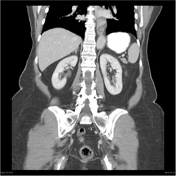File:Carcinoid tumor of the ileum with metastasis to orbit (Radiopaedia 28165-28425 B 23).jpg