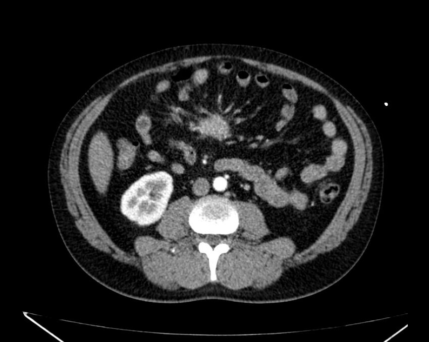 Carcinoid tumor with hepatic metastases (Radiopaedia 22651-22670 B 47).jpg