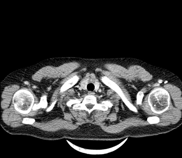 File:Carcinoid tumor with hepatic metastases (Radiopaedia 22651-22670 C 1).jpg