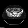 Carcinoma cervix- recurrence (Radiopaedia 34702-36137 B 38).jpg