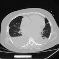 Cardiogenic pulmonary edema (Radiopaedia 29213-29609 Axial lung window 59).jpg