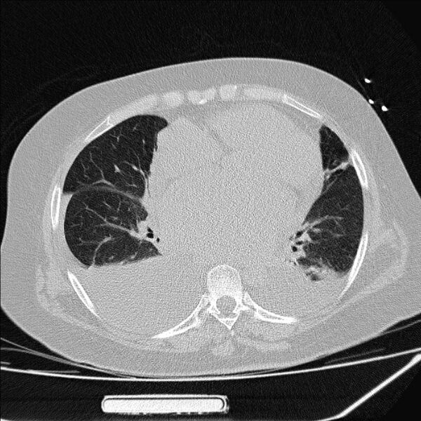 File:Cardiogenic pulmonary edema (Radiopaedia 29213-29609 Axial lung window 59).jpg