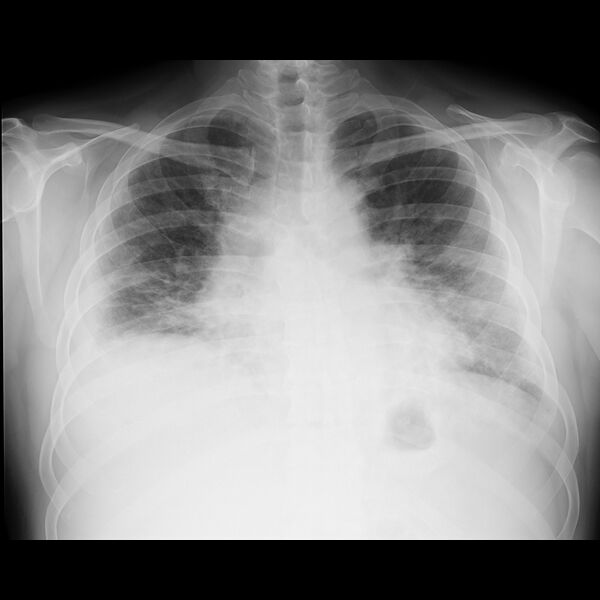 File:Cardiogenic pulmonary edema (Radiopaedia 68180-77677 Frontal 1).jpg