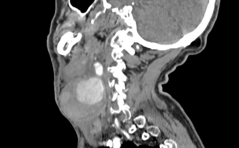 File:Carotid artery pseudoaneurysm (Radiopaedia 84030-99259 E 27).jpg
