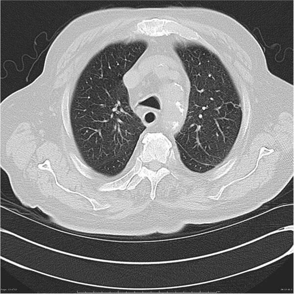 File:Cavitating left lower lobe lesion - squamous cell lung cancer (Radiopaedia 27749-28176 Axial lung window 13).jpg