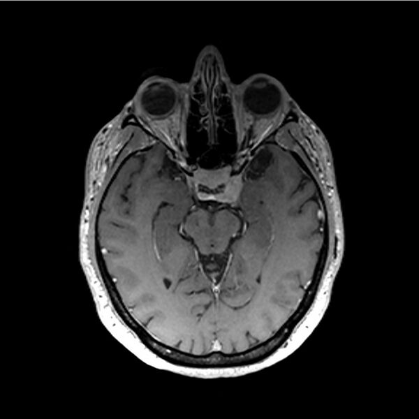 File:Central base of skull meningioma (Radiopaedia 53531-59549 Axial T1 C+ 23).jpg