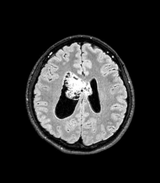 File:Central neurocytoma (Radiopaedia 79320-92380 Axial FLAIR 114).jpg