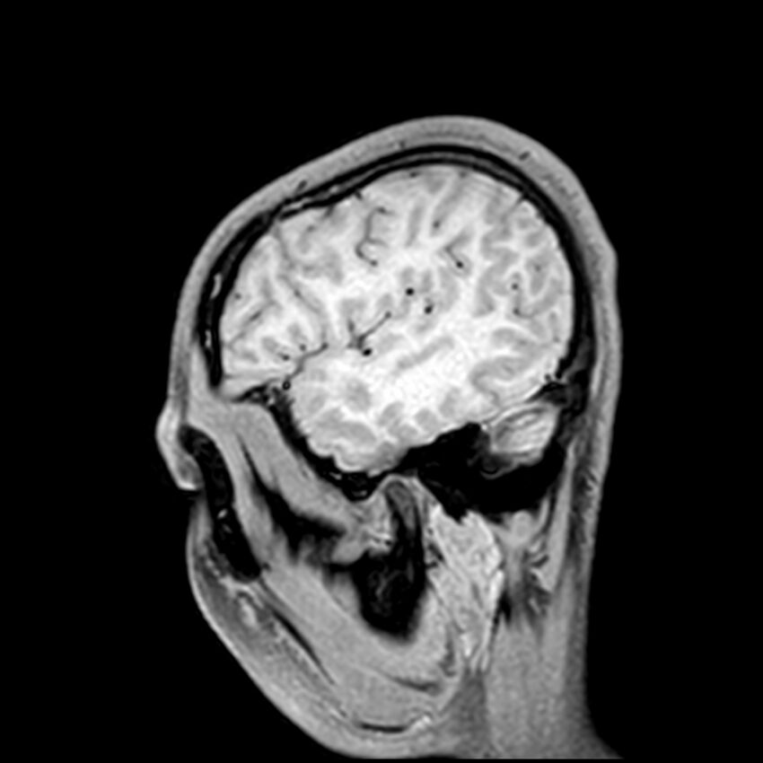 Central neurocytoma (Radiopaedia 79320-92380 Sagittal T1 51).jpg