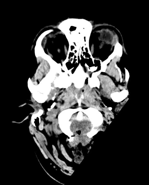 File:Cerebellar ependymoma complicated by post-operative subdural hematoma (Radiopaedia 83322-97737 Axial non-contrast 27).png