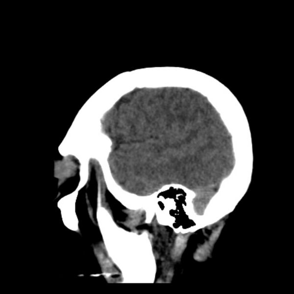 File:Cerebellar hemorrhage causing obstructive hydrocephalus (Radiopaedia 33989-35207 B 39).jpg