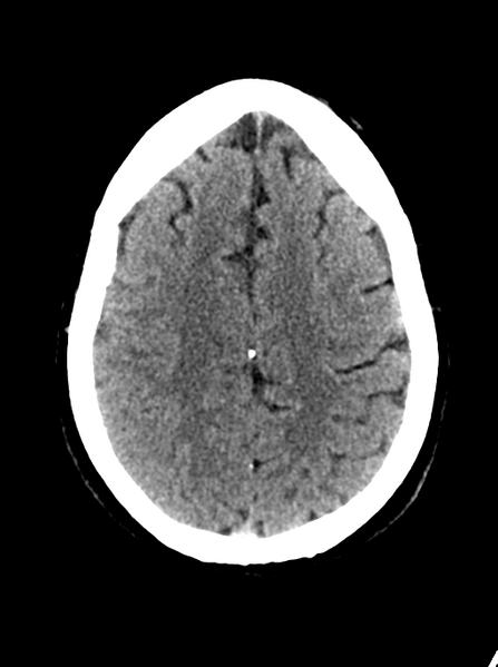 File:Cerebellar infarct due to vertebral artery dissection with posterior fossa decompression (Radiopaedia 82779-97032 Axial non-contrast 23).png