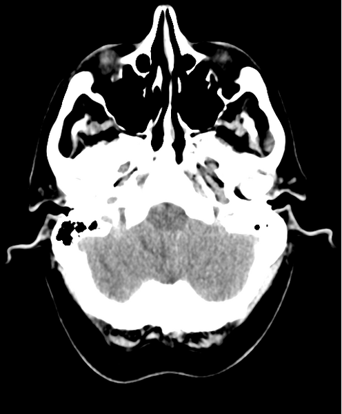 File:Cerebellar metastasis from lung adenocarcinoma (Radiopaedia 86690-102828 Axial non-contrast 5).png