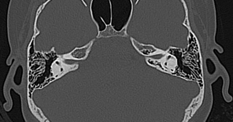File:Cerebellopontine angle lipoma (Radiopaedia 57303-64242 Axial bone window 35).jpg