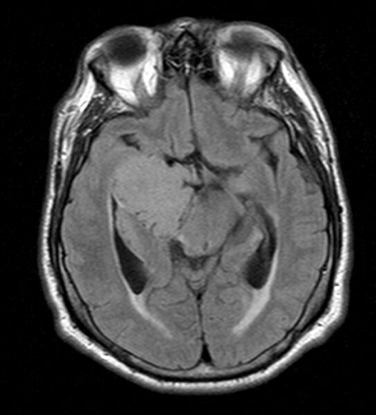 File:Cerebellopontine angle meningioma (Radiopaedia 24459-24764 Axial FLAIR 11).jpg