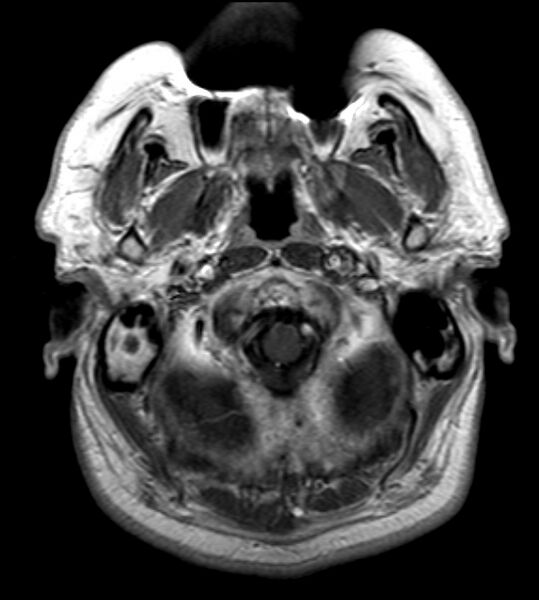 File:Cerebellopontine angle meningioma (Radiopaedia 24459-24764 Axial T1 C+ 2).jpg