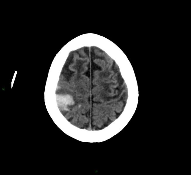 File:Cerebral amyloid angiopathy-associated lobar intracerebral hemorrhage (Radiopaedia 58376-65513 Axial non-contrast 11).jpg