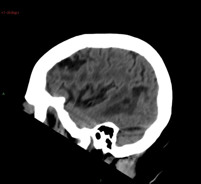 File:Cerebral amyloid angiopathy-associated lobar intracerebral hemorrhage (Radiopaedia 58378-65518 C 20).jpg