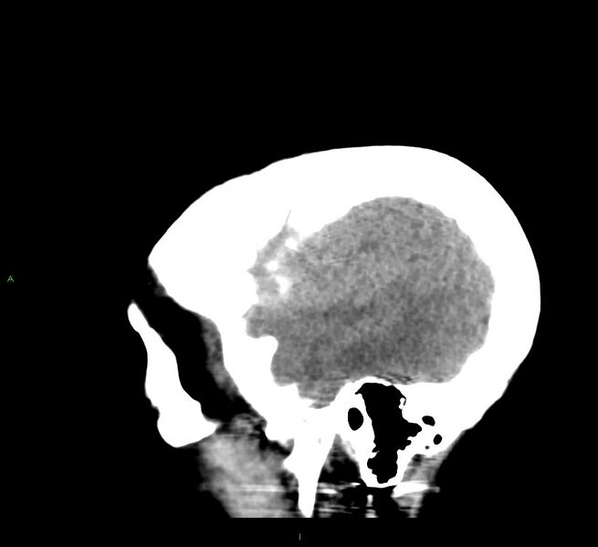 File:Cerebral amyloid angiopathy-associated lobar intracerebral hemorrhage (Radiopaedia 58379-65519 C 45).jpg