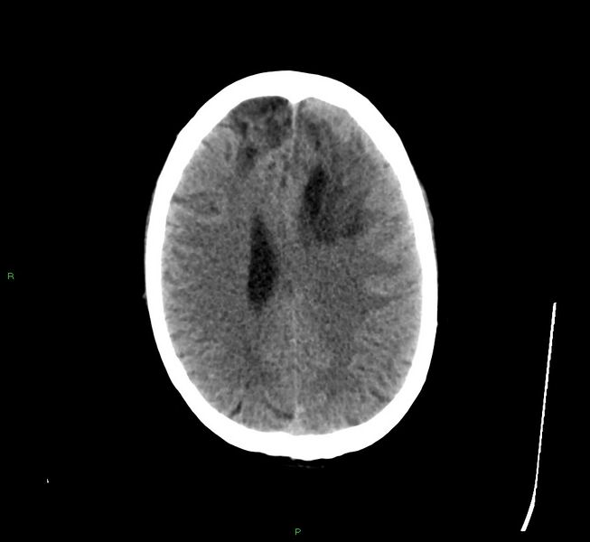 File:Cerebral amyloid angiopathy-associated lobar intracerebral hemorrhage (Radiopaedia 58529-65681 Axial non-contrast 18).jpg