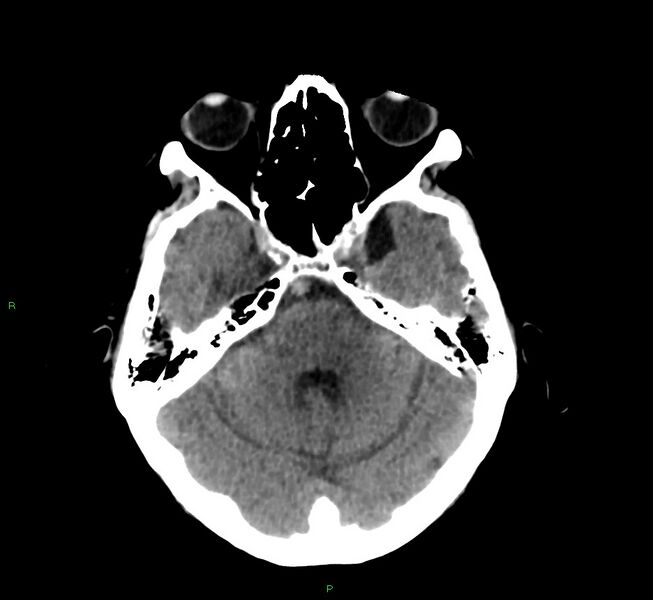 File:Cerebral amyloid angiopathy-associated lobar intracerebral hemorrhage (Radiopaedia 58530-65688 Axial non-contrast 36).jpg