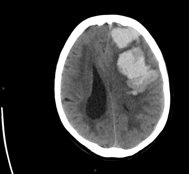 File:Cerebral amyloid angiopathy-associated lobar intracerebral hemorrhage (Radiopaedia 58561-65724 Axial non-contrast 18).jpg