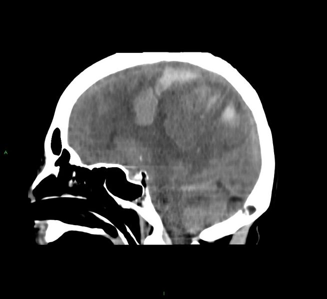 File:Cerebral amyloid angiopathy-associated lobar intracerebral hemorrhage (Radiopaedia 58751-65972 C 27).jpg