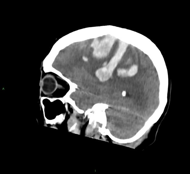 File:Cerebral amyloid angiopathy-associated lobar intracerebral hemorrhage (Radiopaedia 58756-65977 C 20).jpg