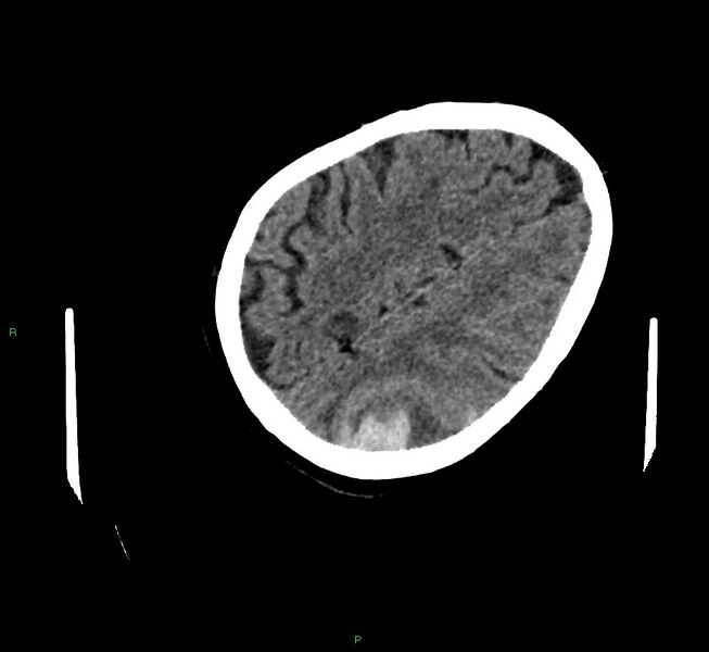 File:Cerebral amyloid angiopathy-associated lobar intracerebral hemorrhage (Radiopaedia 58757-65979 Axial non-contrast 106).jpg