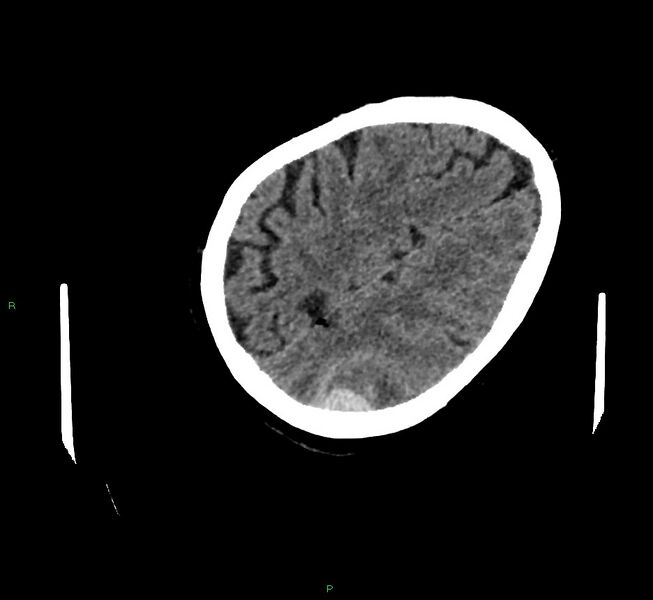 File:Cerebral amyloid angiopathy-associated lobar intracerebral hemorrhage (Radiopaedia 58757-65979 Axial non-contrast 108).jpg