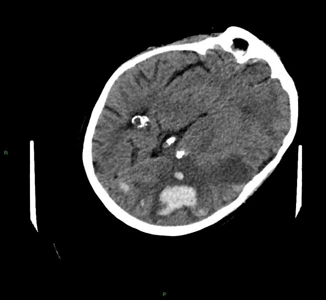 File:Cerebral amyloid angiopathy-associated lobar intracerebral hemorrhage (Radiopaedia 58757-65979 Axial non-contrast 55).jpg