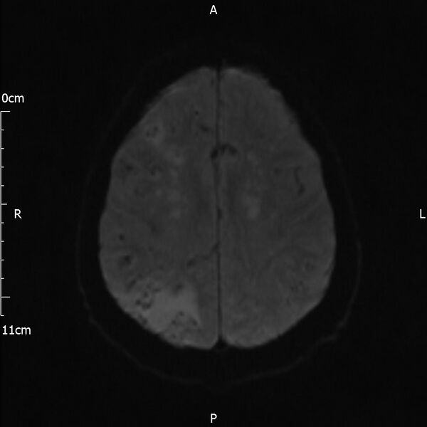 File:Cerebral amyloid angiopathy related inflammation (Radiopaedia 72772-83415 Axial DWI 40).jpg