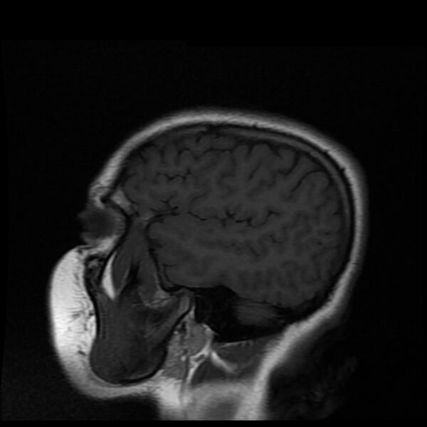 File:Cerebral cavernous malformation (Radiopaedia 44301-47942 Sagittal T1 18).jpg