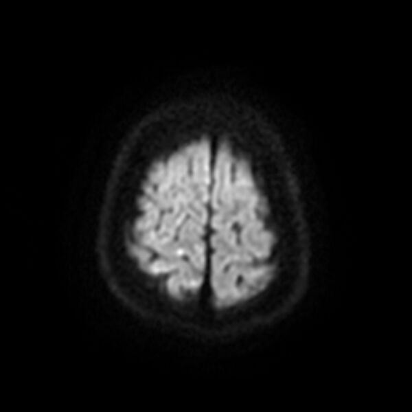 File:Cerebral fat embolism (Radiopaedia 37510-39363 Axial DWI 23).jpg