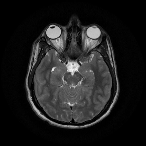 File:Cerebral fat embolism (Radiopaedia 37510-39363 Axial T2 11).jpg