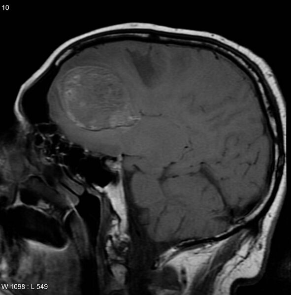 File:Cerebral metastases - renal cell carcinoma (Radiopaedia 5510-7246 Sagittal T1 4).jpg