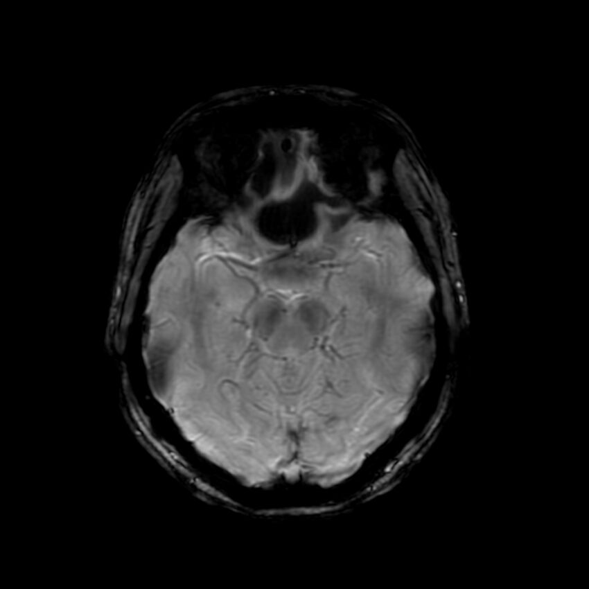 Cerebral paragonimiasis (Radiopaedia 73473-84238 Axial SWI 27).jpg